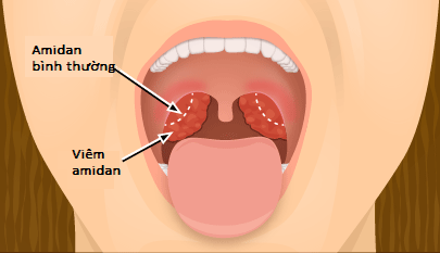 nguyên nhân viêm amidan