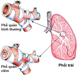 viêm phế quản là gì 